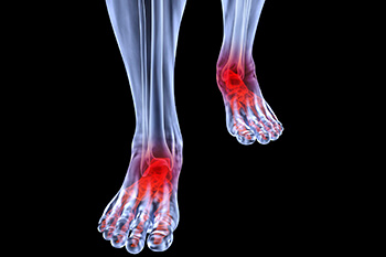 arthritic foot and ankle care treatment in the Miami-Dade County, FL: Miami (Hialeah, Miami Gardens, Miami Beach, Kendall, Doral, North Miami, Fontainebleau, Tamiami, Westchester, Coral Gables, Hialeah Gardens, Sweetwater, Gladeview) areas