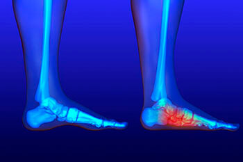 Flat feet and Fallen Arches treatment in the Miami-Dade County, FL: Miami (Hialeah, Miami Gardens, Miami Beach, Kendall, Doral, North Miami, Fontainebleau, Tamiami, Westchester, Coral Gables, Hialeah Gardens, Sweetwater, Gladeview) areas