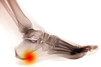 Heel spurs treatment in the Miami-Dade County, FL: Miami (Hialeah, Miami Gardens, Miami Beach, Kendall, Doral, North Miami, Fontainebleau, Tamiami, Westchester, Coral Gables, Hialeah Gardens, Sweetwater, Gladeview) areas