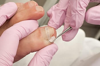 Ingrown toenails treatment in the Miami-Dade County, FL: Miami (Hialeah, Miami Gardens, Miami Beach, Kendall, Doral, North Miami, Fontainebleau, Tamiami, Westchester, Coral Gables, Hialeah Gardens, Sweetwater, Gladeview) areas