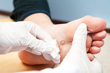 Plantar warts treatment in the Miami-Dade County, FL: Miami (Hialeah, Miami Gardens, Miami Beach, Kendall, Doral, North Miami, Fontainebleau, Tamiami, Westchester, Coral Gables, Hialeah Gardens, Sweetwater, Gladeview) areas