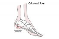 Relationship of Heel Spurs to Plantar Fasciitis